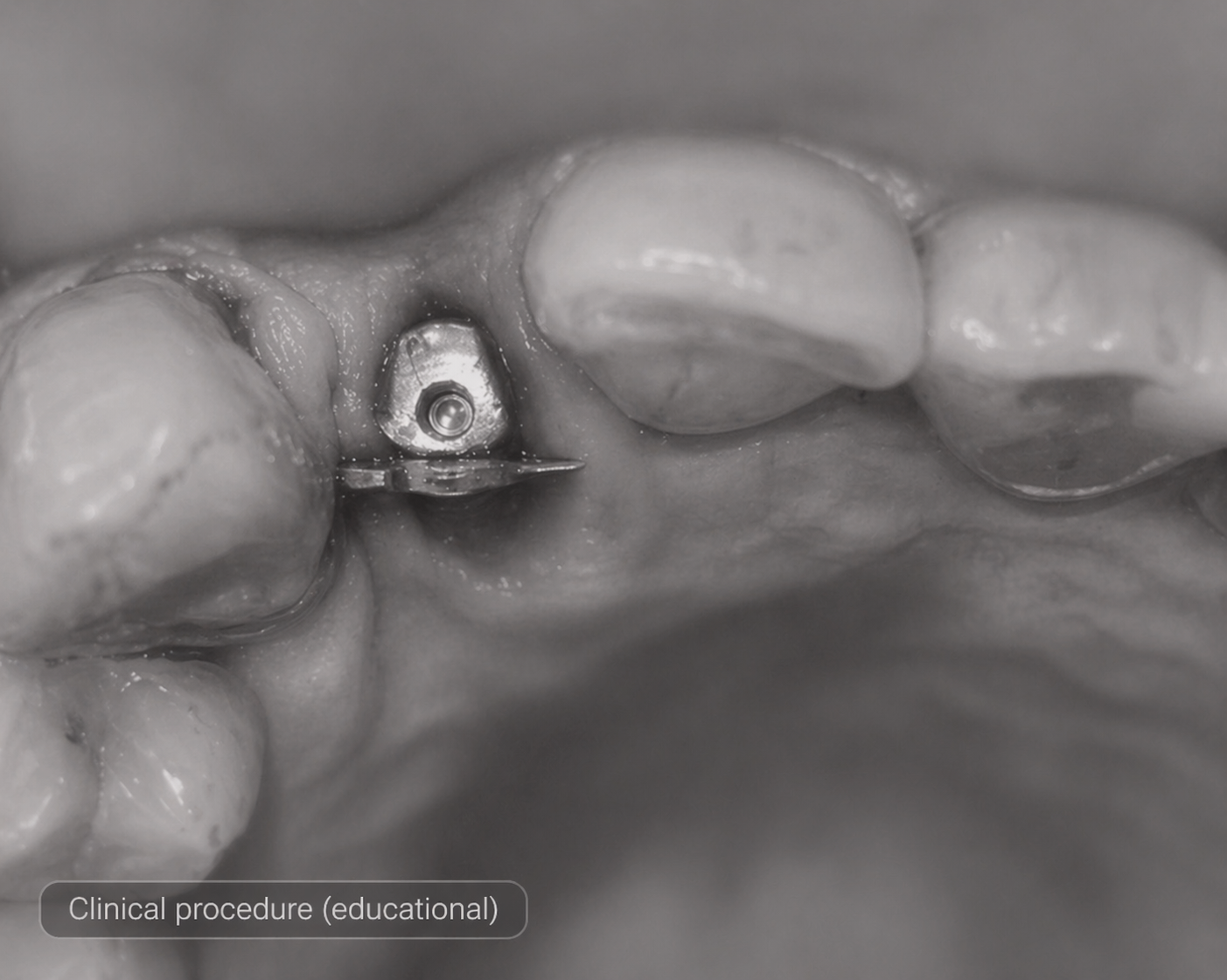 Close-up dental implant detail — Aura Dental Care, Citrus Heights CA