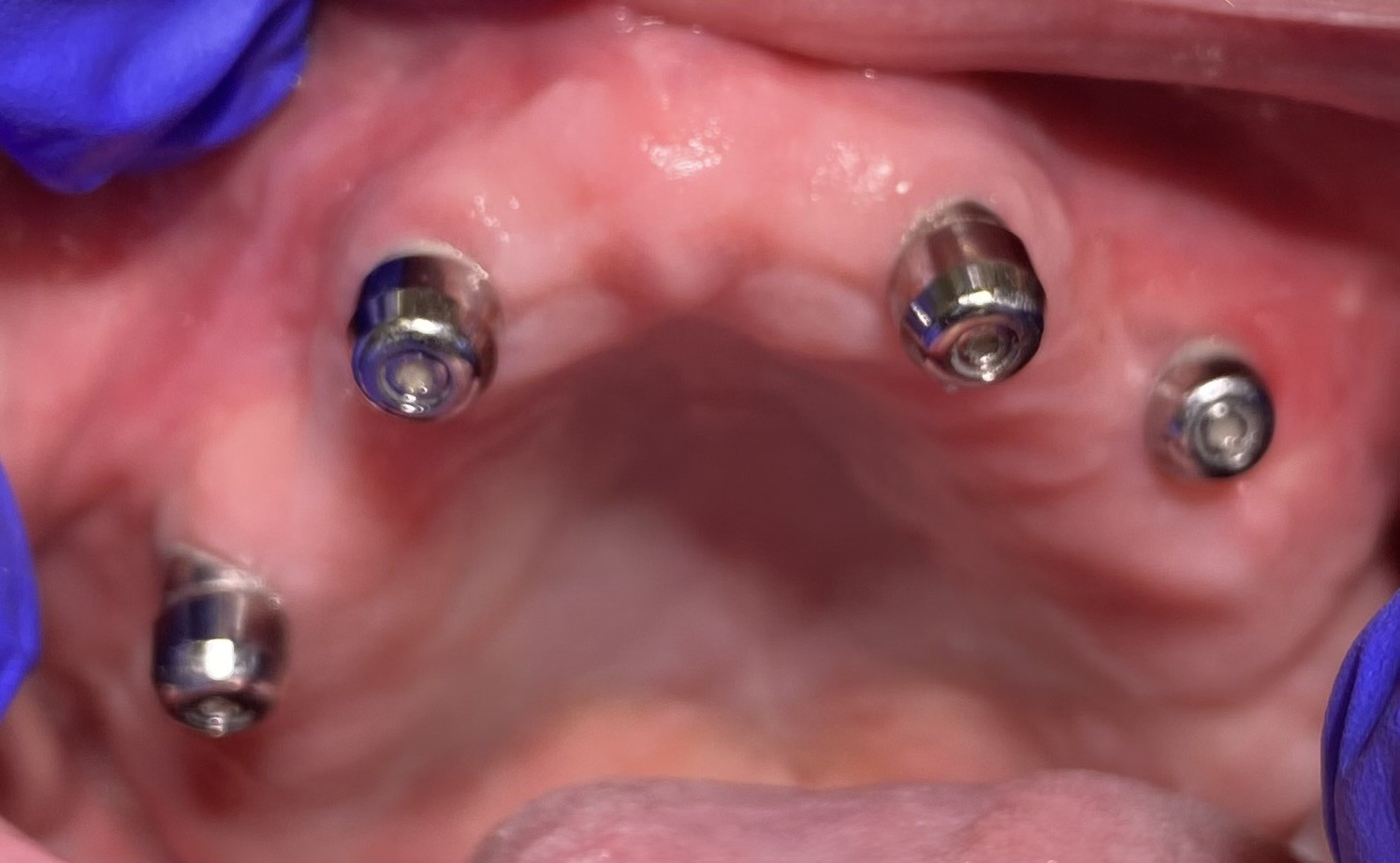 Fixed implant denture case 2 — Aura Dental Care Citrus Heights CA