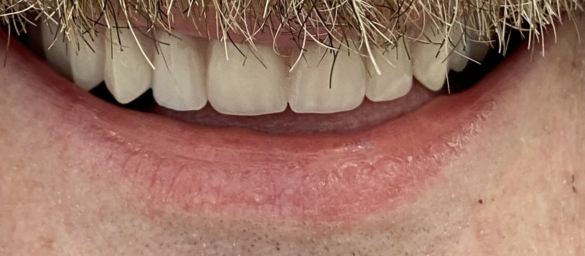 Fixed implant-supported denture case 3 — dental implants Citrus Heights CA