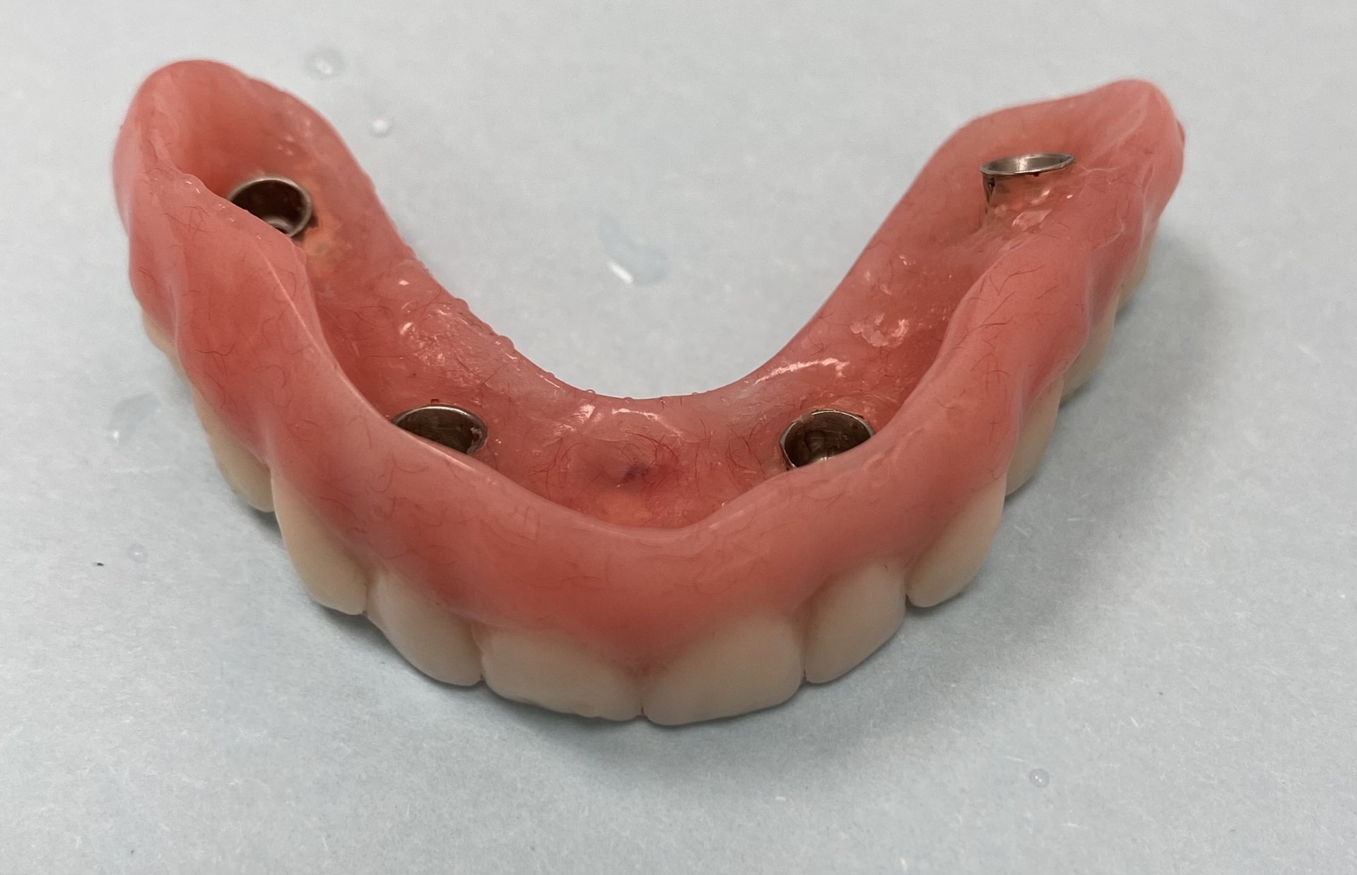 Fixed implant-supported denture case — Citrus Heights dentist