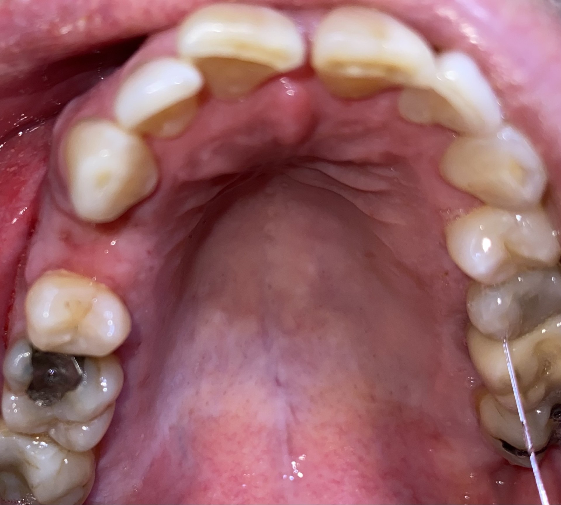 Dental implant clinical case 3 — Citrus Heights CA