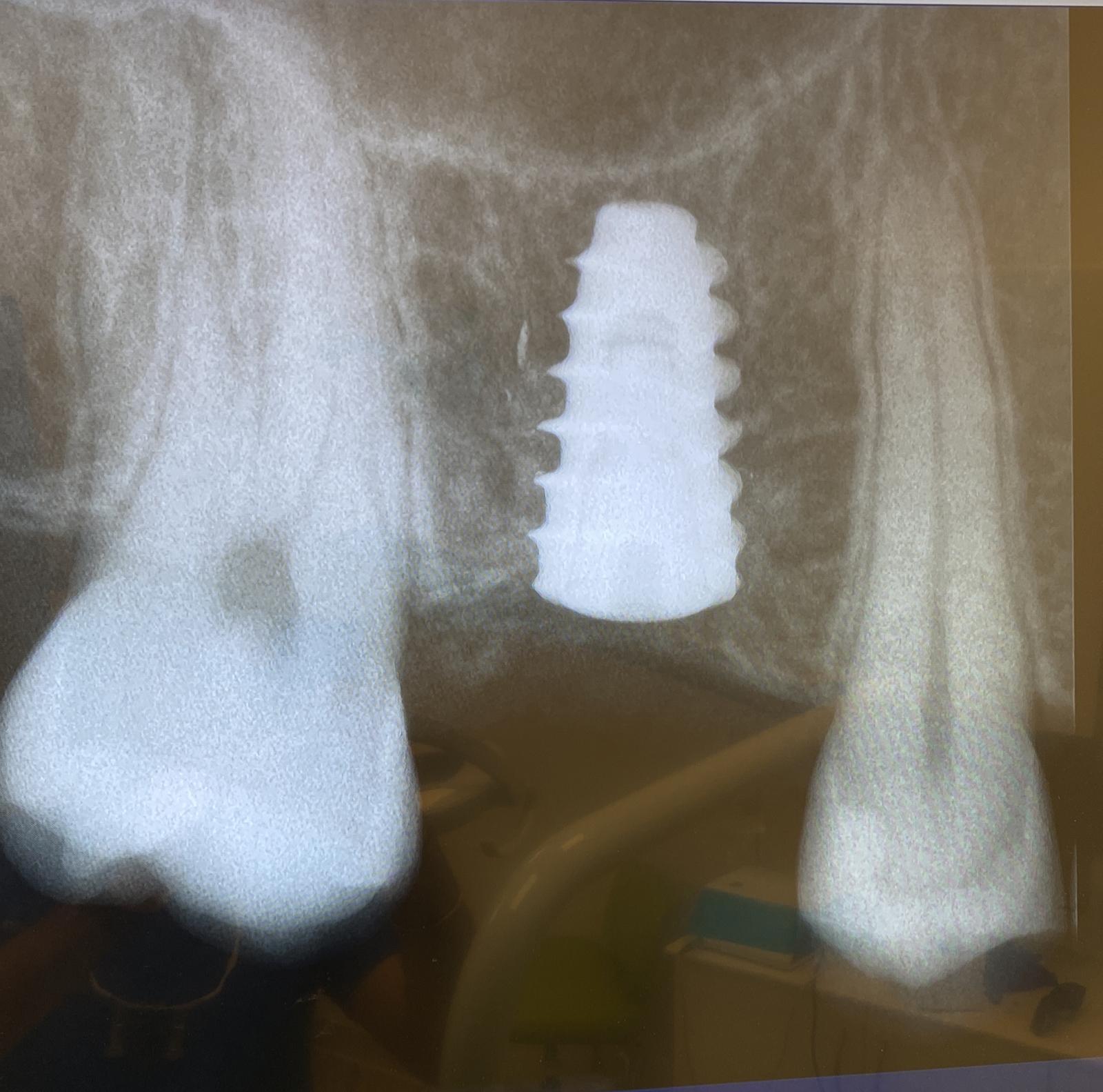 Dental implant case 4 — Aura Dental Care Citrus Heights