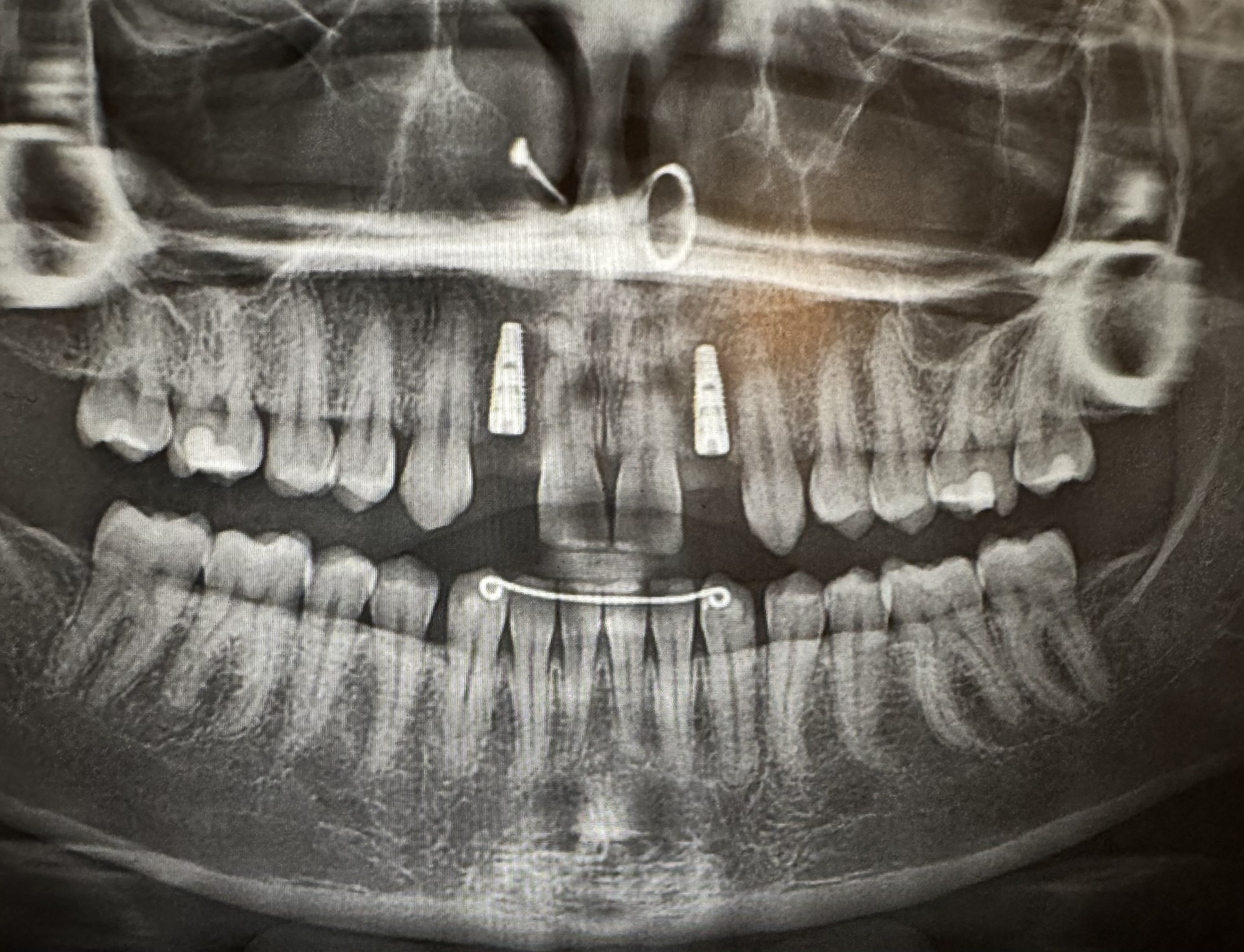 Dental implant case 5 — Citrus Heights implant dentistry