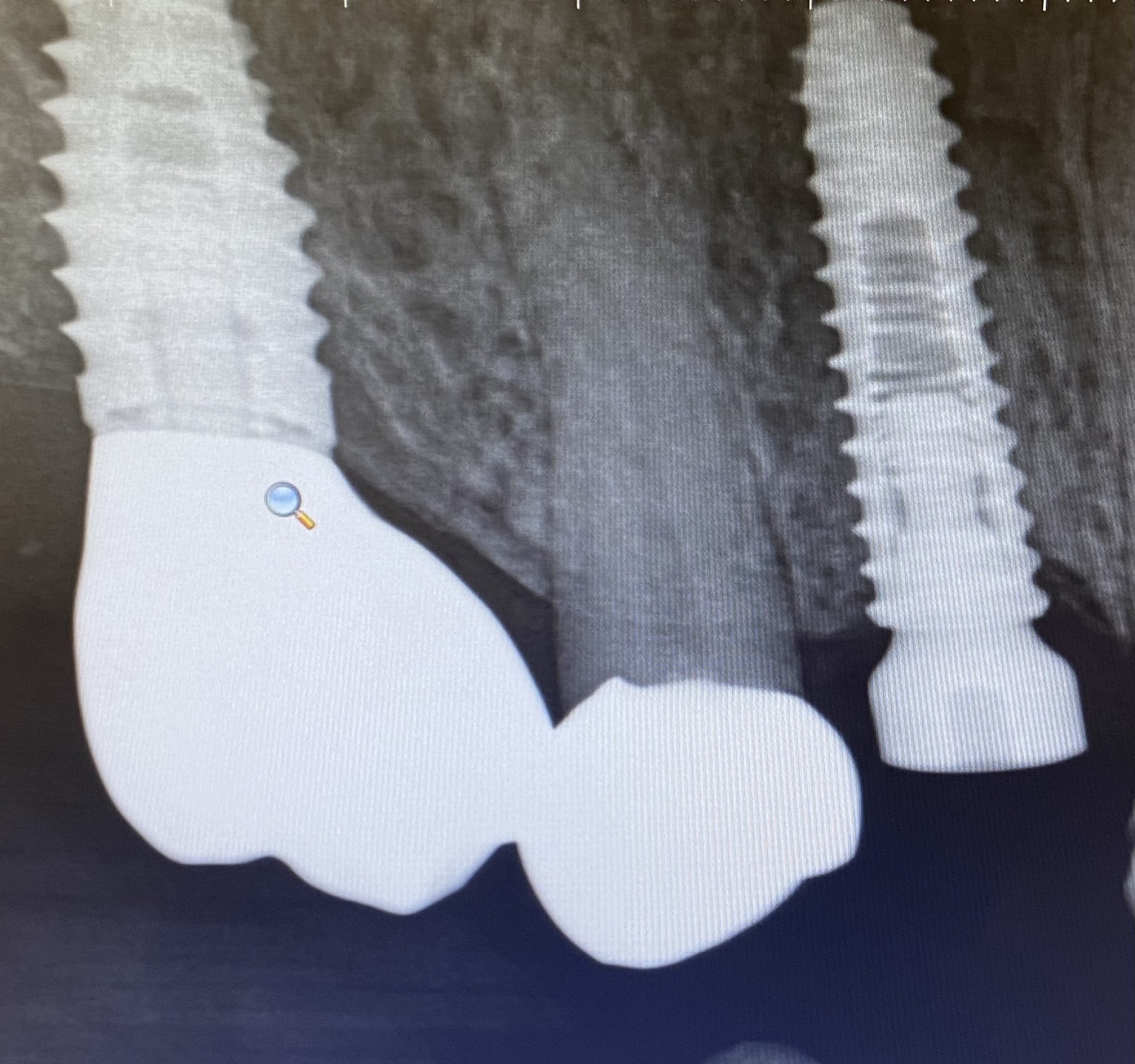 Dental implant radiograph case 2 — Aura Dental Care