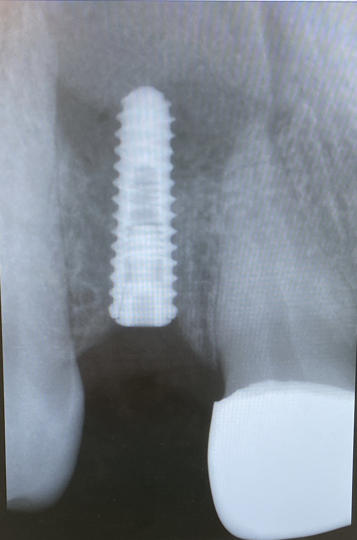 Dental implant X-ray case — Citrus Heights implant dentist