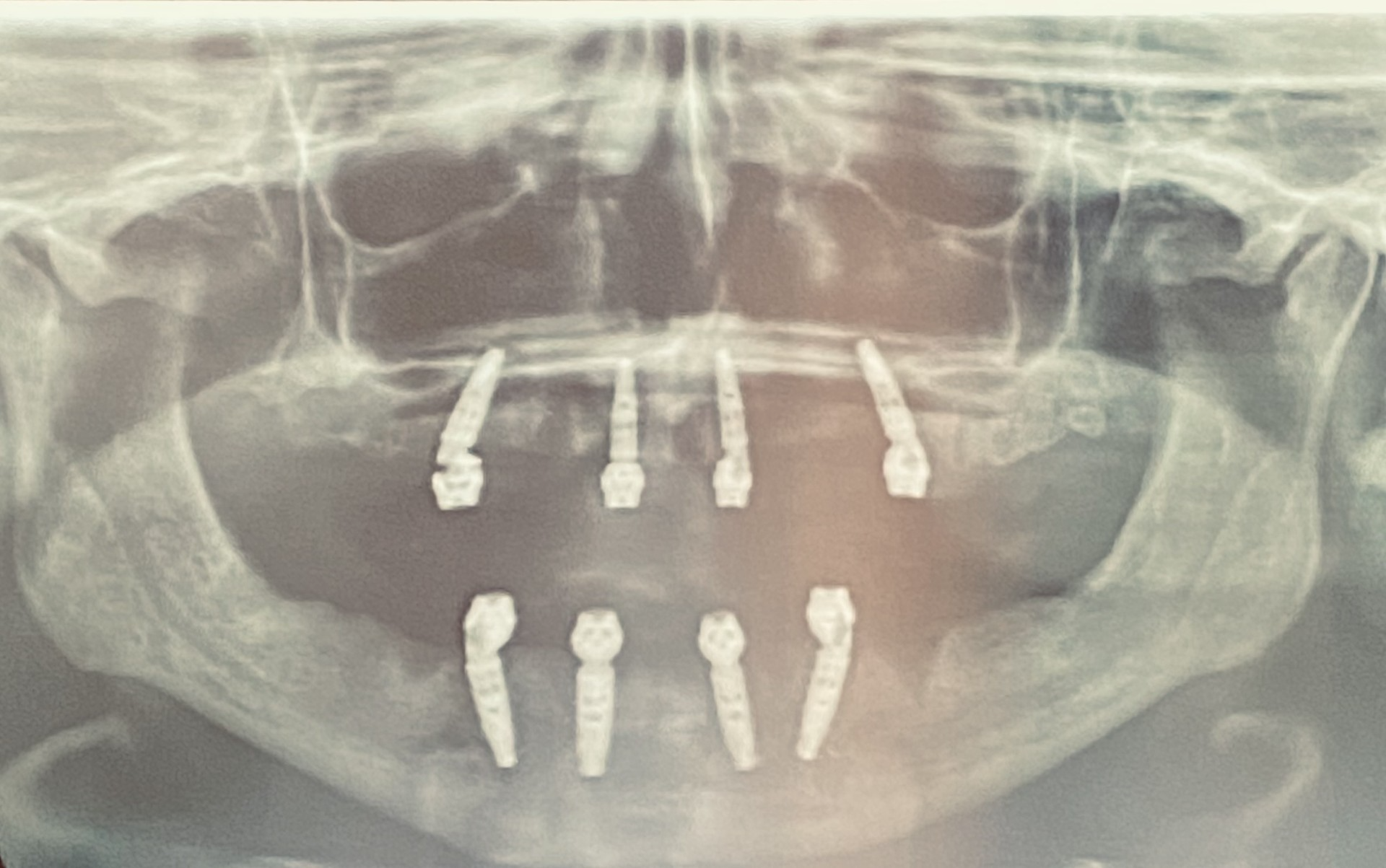 All-on-4 dental implant case 1 — Citrus Heights CA dentist