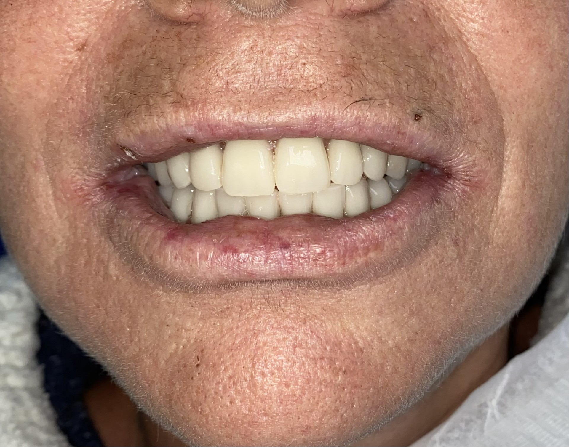 All-on-4 dental implant case 2 — Aura Dental Care Citrus Heights